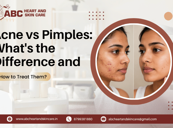 Acne vs Pimples What's the Difference and How to Treat Them