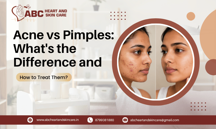 Acne vs Pimples What's the Difference and How to Treat Them