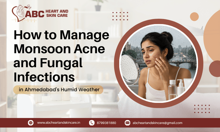 How to Manage Monsoon Acne and Fungal Infections in Ahmedabad's Humid Weather